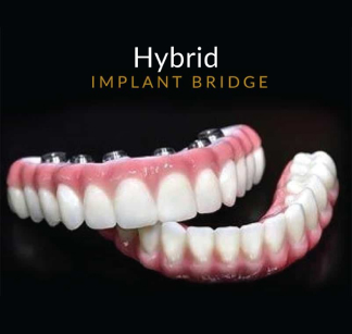 Hybrid implant bridge