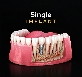 Single Implant